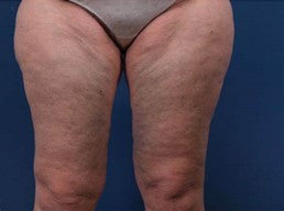 Stretch marks and cellulite