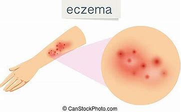 Eczema, Dermatitis (Peri) and Psoriasis