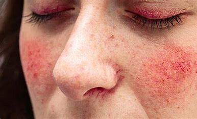 The Dermal Aesthetics Approach to Rosacea